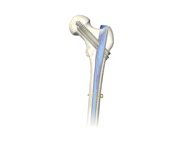 Implant OEM